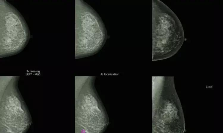 AI Effectively Detects Interval Breast Cancer In Subsequent Two Years Post-Screening By Mammograms: Study