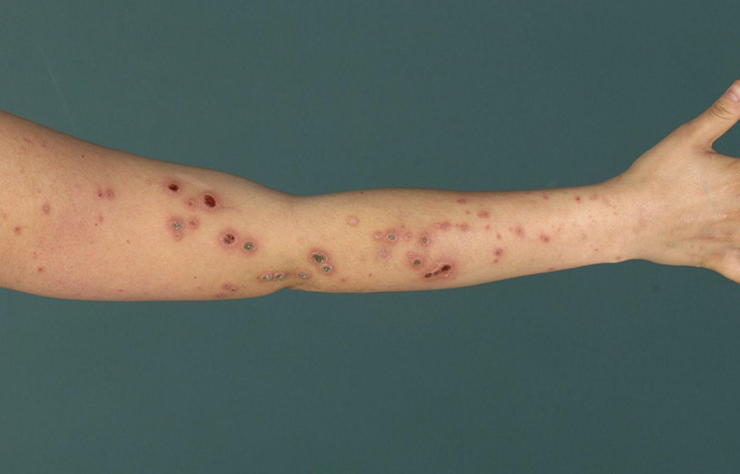 50% Of CAPS Patients Present With Cutaneous Involvements, Including Distal Inflammatory Edema: JAMA