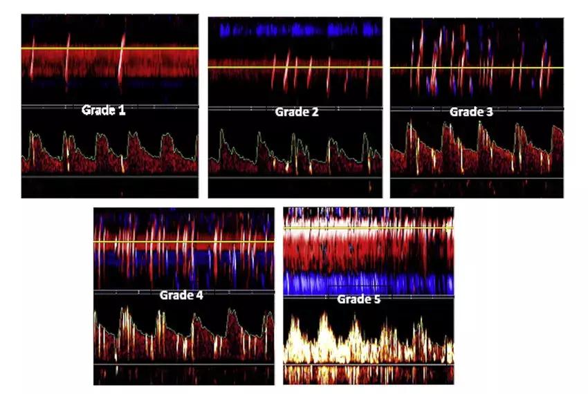 Transcranial Doppler Very Sensitive For Detection Of Even Smaller Right-To-Left Shunts