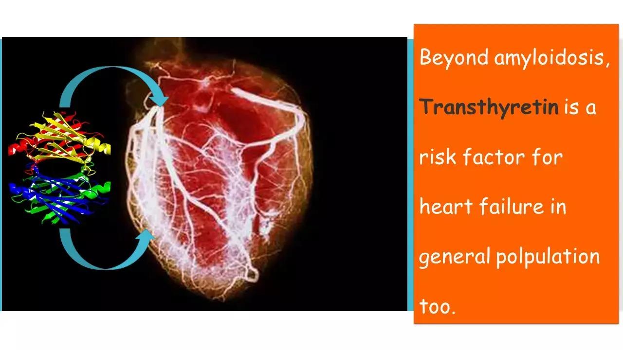 Misfolded Transthyretin: A Novel Risk Factor For Heart Failure, JAMA Study
