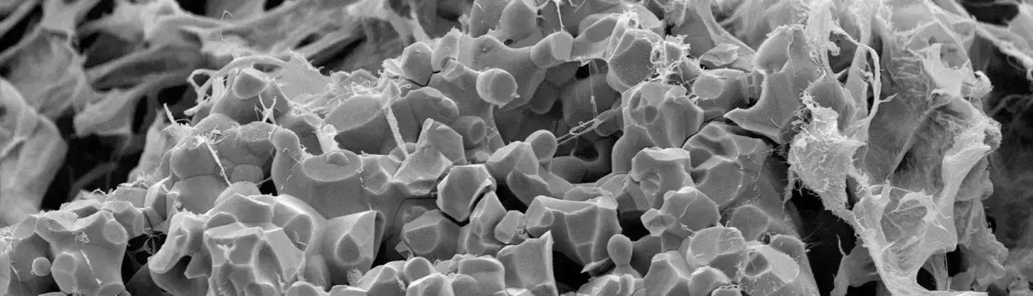 Cerasorb Reliable Bone Graft Substitute With Low Complication Rates For Curettage Of Bone Tumors