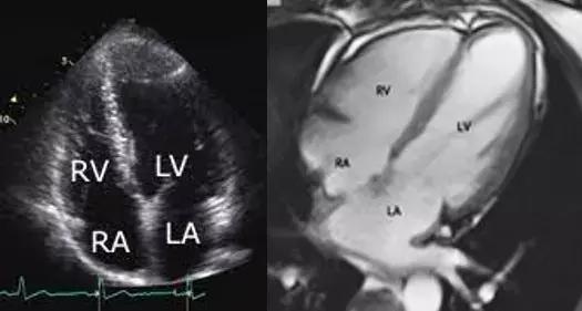Regression Of Myocardial Fibrosis Improves Cardiac Function And Functional Status: Finds Study