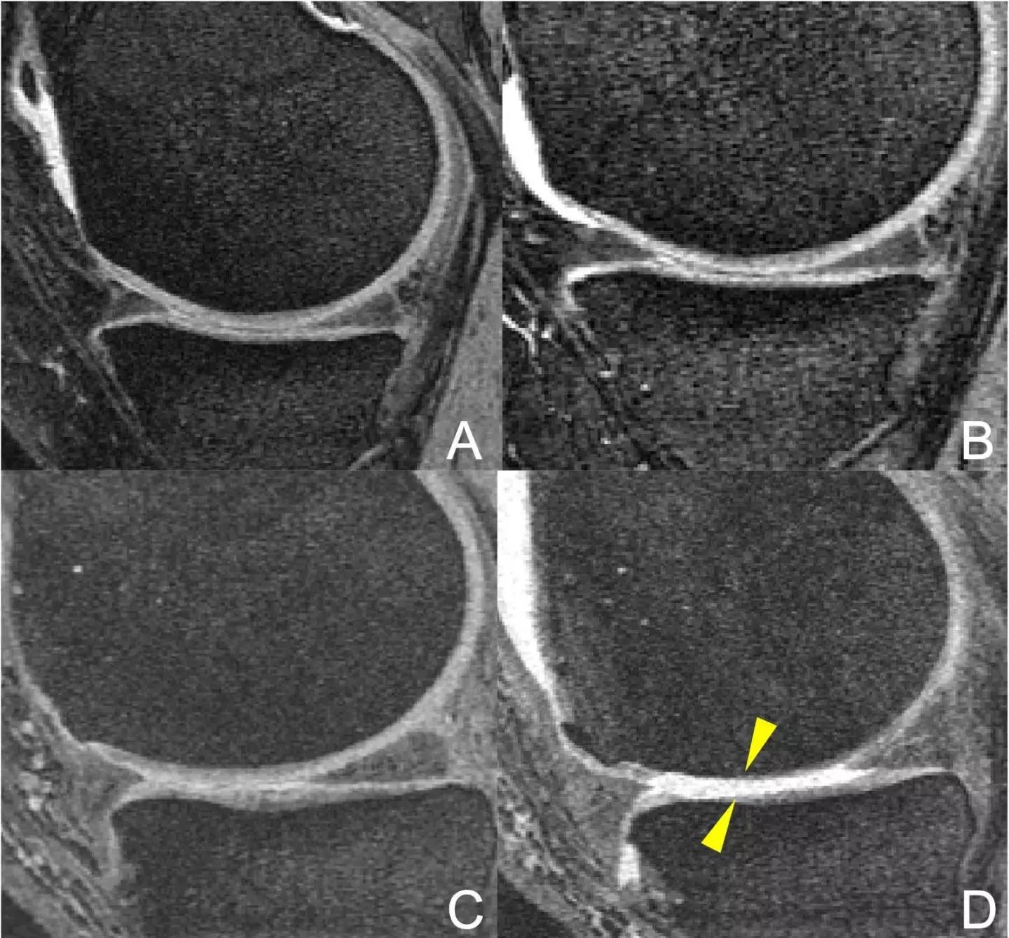 Racket Sports Rapidly Destroy Cartilage In Knee Osteoarthritis In Obese, Finds MRI Study