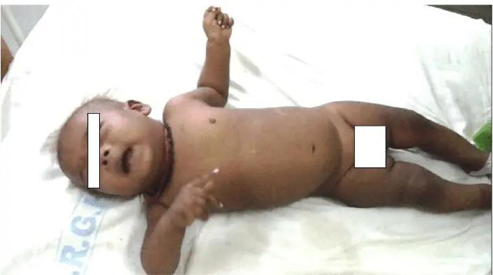 Propranolol Benefits Infantile Tremor Syndrome After Initiating Vitamin B12 Therapy: Case Study