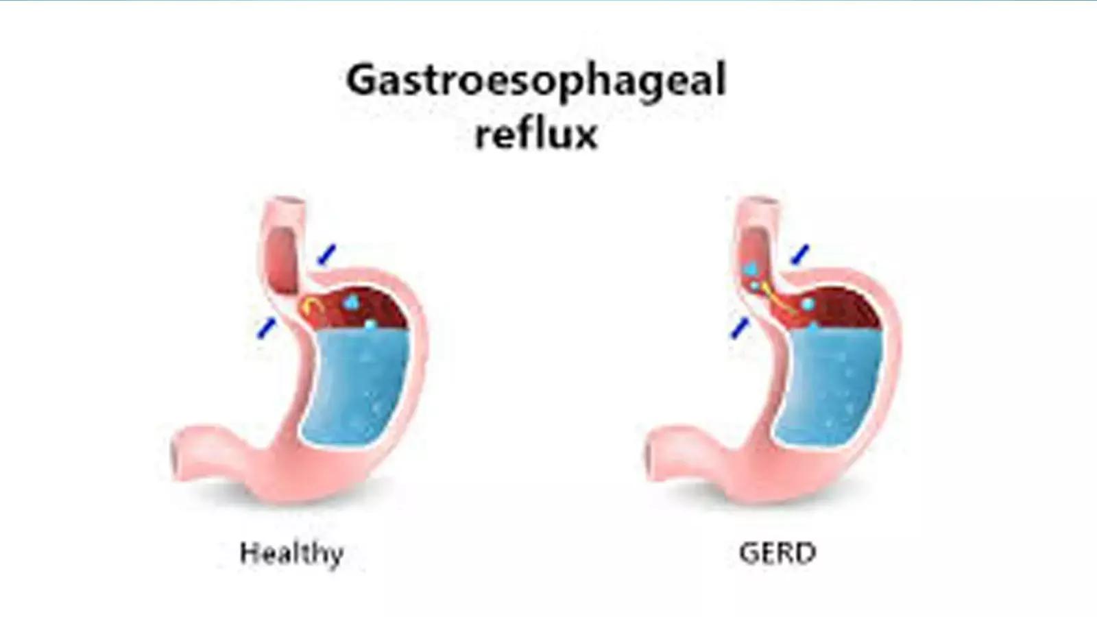 Diet And Lifestyle Changes Can Reduce GERD Symptoms Beyond Acid Suppression: JAMA