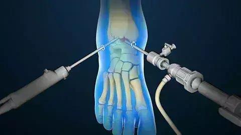 Arthroscopic Modified Brostrom Procedure Superior To Open Procedure For Treatment Of ATFL Injury: Study