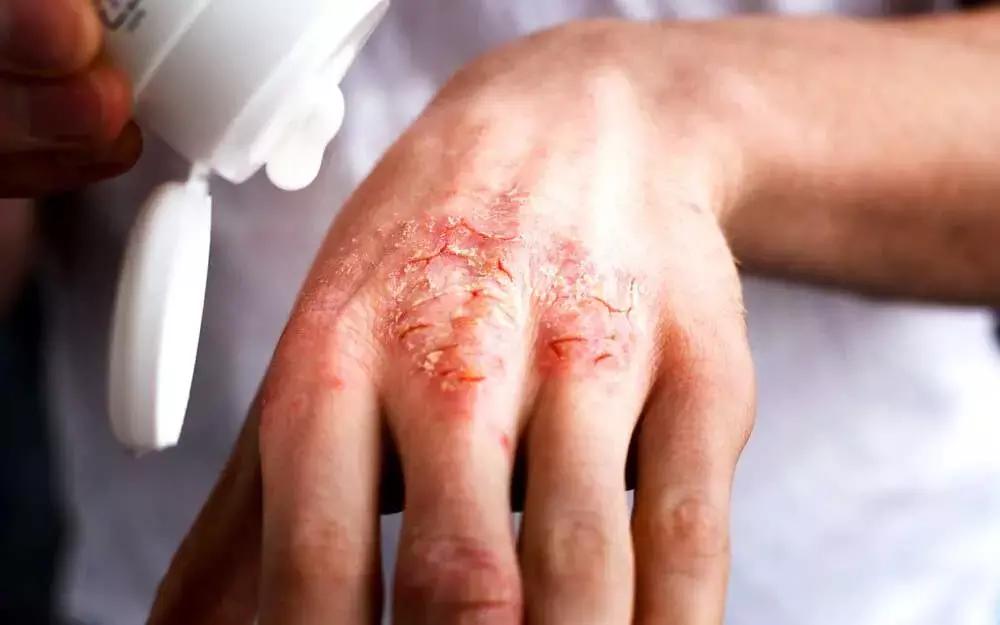 Tralokinumab Monotherapy Effective In Moderate-To-Severe Atopic Dermatitis: Study