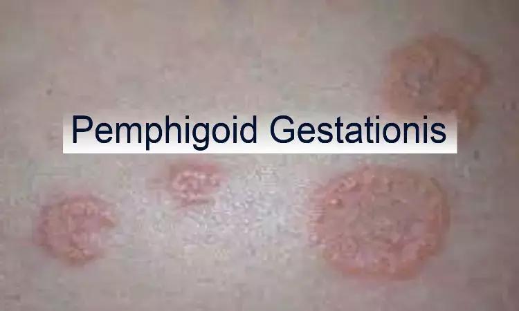Case Of Pemphigoid Gestationis Reported In NEJM