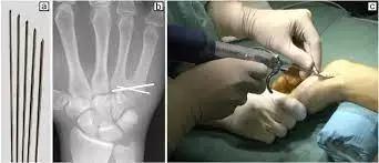 U-Shaped Kirschner Wire Internal Fixation Safe And Effective Treatment For Skier'S Thumb: Study