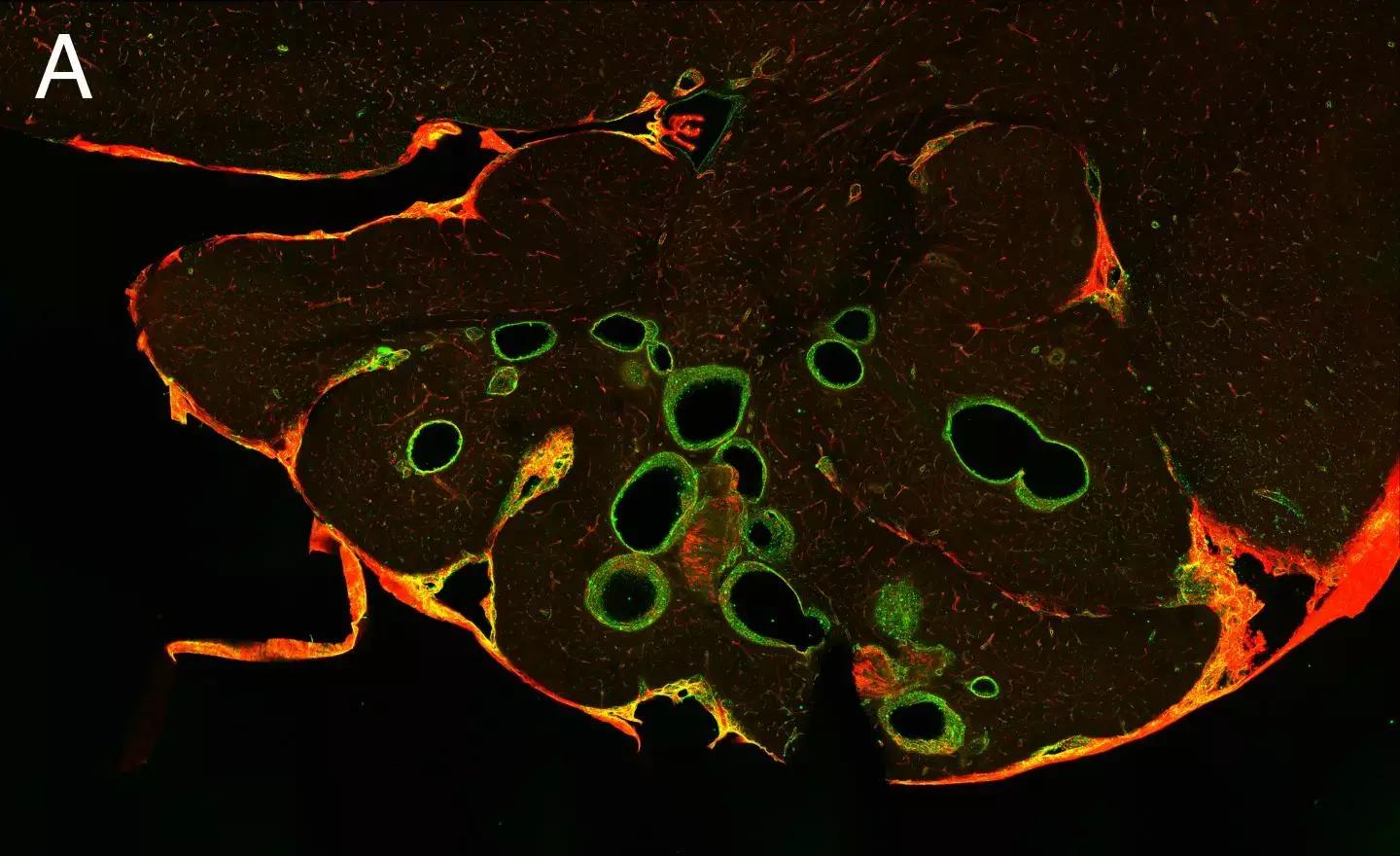 Beta Blockers Can Repair Malformed Blood Vessels In The Brain
