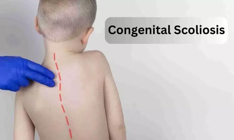 Curve Size Predicts Success Of Limited Fusion For Congenital Scoliosis, Suggests Study