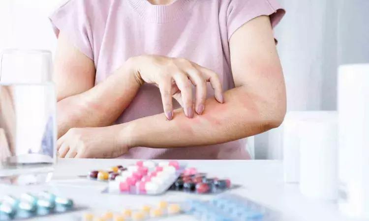 Oral Antibiotics Tied To Higher Risk Of Serious Skin Reactions: Sulfonamides And Cephalosporins Pose Greatest Threat, Study Finds