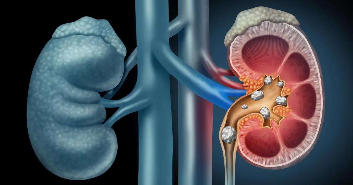 Extracorporeal Shock Wave Lithotripsy With Ultrasound Monitoring Tied To Higher Stone-Free Rate