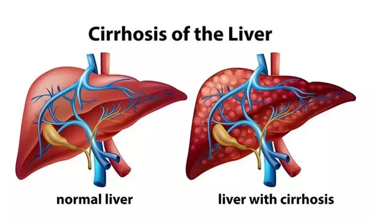 Carvedilol Improves Survival In Cirrhosis Patients: Study