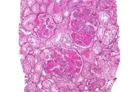 Tacrolimus An Alternative To IV Cyclophosphamide As Initial Therapy For Lupus Nephritis
