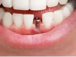 Diabetes Impairs Dental Implant Prognosis,Finds Study