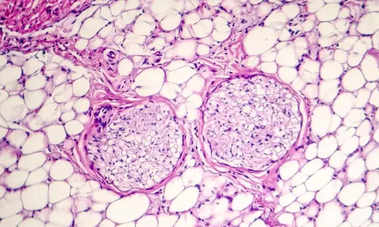 Prophylactic Colchicine Therapy After Ablation In AF Fails To Reduce Incident Pericarditis