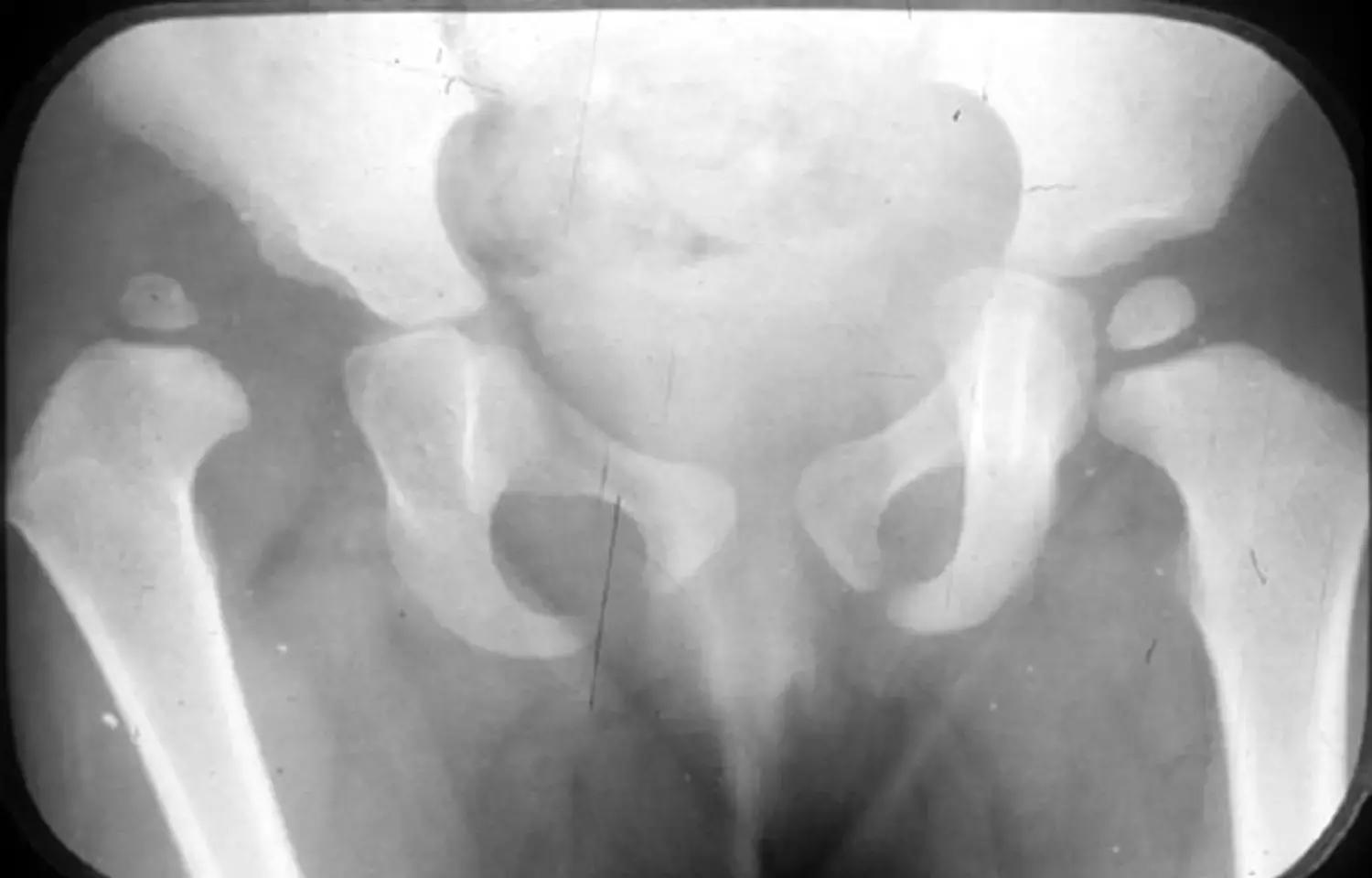 MRI Holds Key For Diagnosis And Treatment Of Developmental Hip Dysplasia: Study
