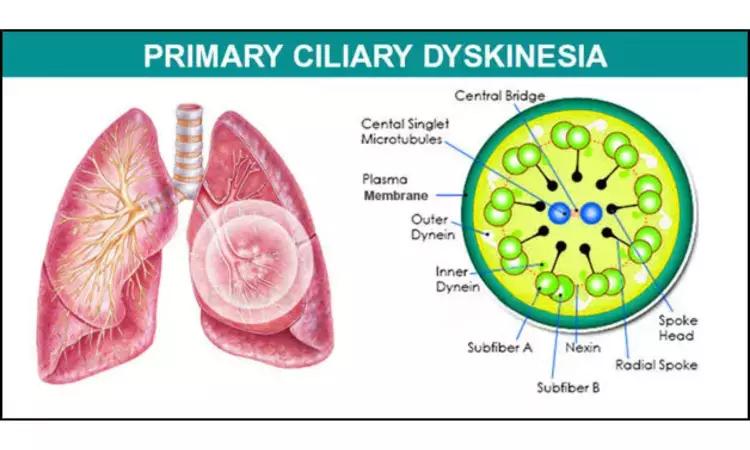 "Advances In The Diagnosis And Treatment Of Primary Ciliary Dyskinesia"- A Review