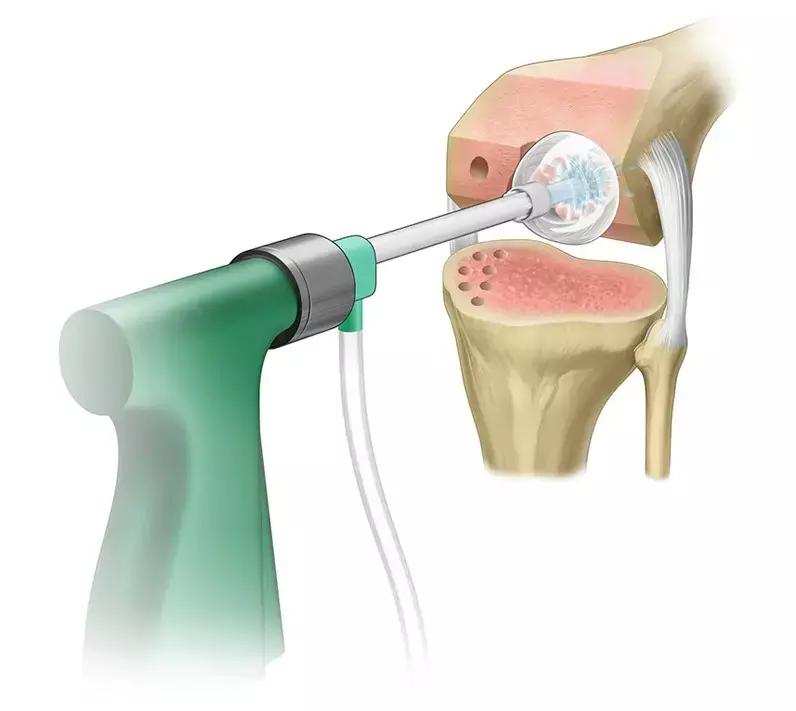 Use Of Pulsed Saline Lavage Cost-Effective Protocol For Prosthetic Joint Infection Prophylaxis After Arthroplasties