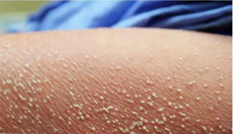 Amoxicillin May Rarely Induce Acute Generalized Exanthematous Pustulosis Which May Be Self Limiting