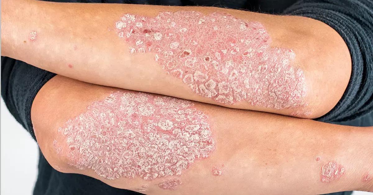 Rheumatoid Arthritis Patients On TNFi At High Risk Of Developing Psoriasis