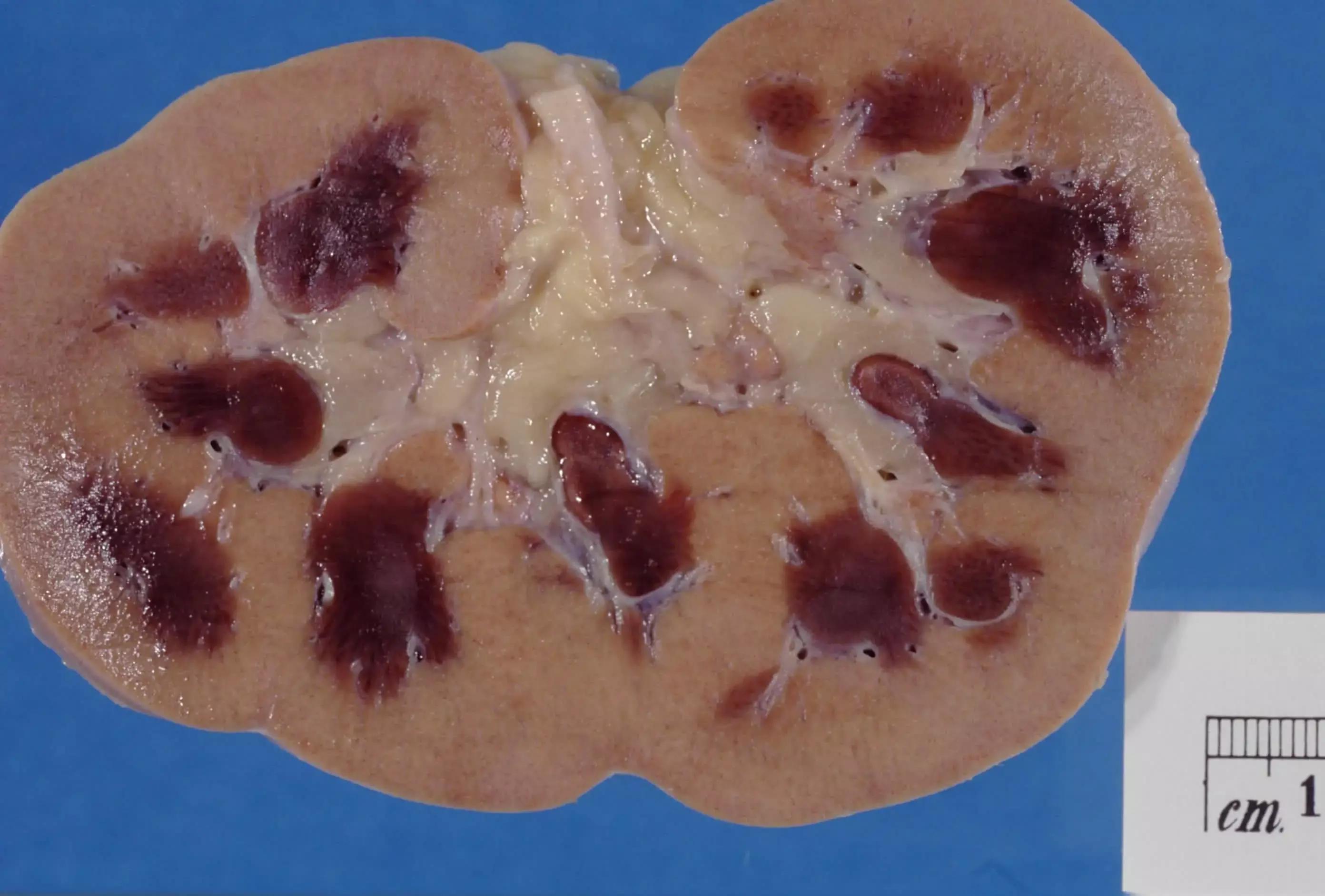 PPI Use Not Significant Risk Factor For Post-Hospitalization AKI And Progression Of Kidney Disease