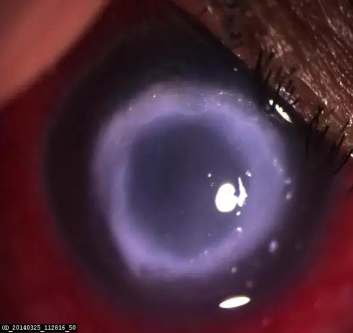 PHMB Monotherapy Effective Alternative To PHMB And Propamidine Combo For Treatment Of Acanthamoeba Keratitis