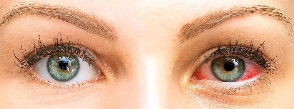 Loteprednol Etabonate Formulated With MPP Technology Effective In Dry Eye Disease