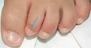 Rare Case Of Anonychia Congenita Reported- A Report