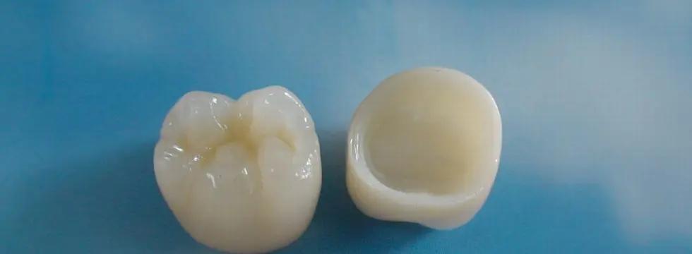 Adapting Occlusal Design And Adjustment May Improve Properties Of Zirconia And Resin Composite Crowns
