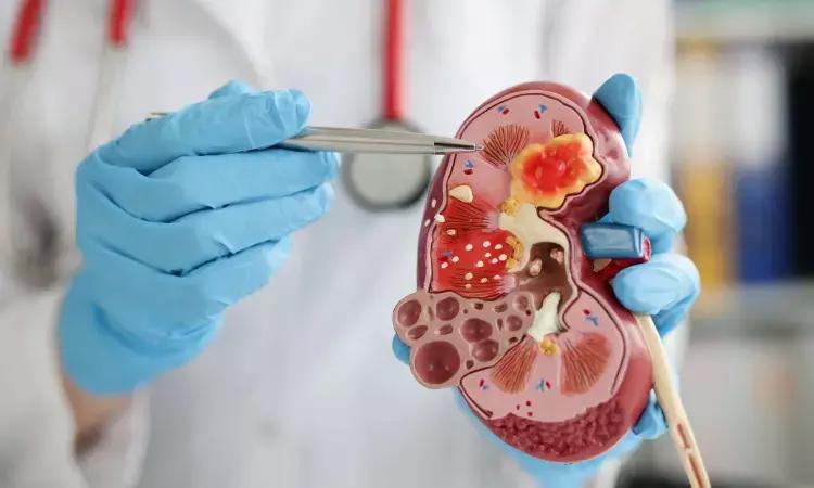 Elevated Consumption Of Added Sugars A Risk Factor For Kidney Stones