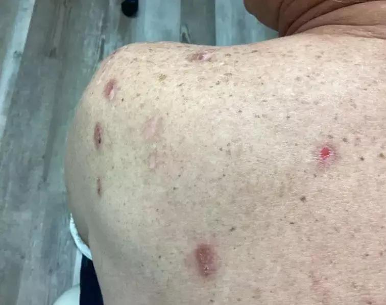 Prurigo Nodularis Closely Associated With Atopic Dermatitis, Finds Recent Research