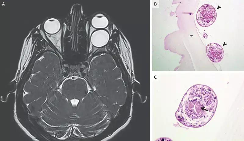 Rare Case Of Orbital Hydatid Cyst Reported In NEJM