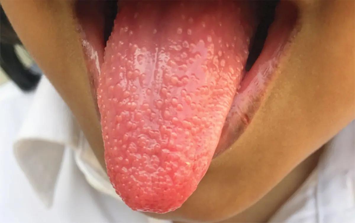 Case Of Strawberry Tongue In Streptococcal Pharyngitis Reported In NEJM