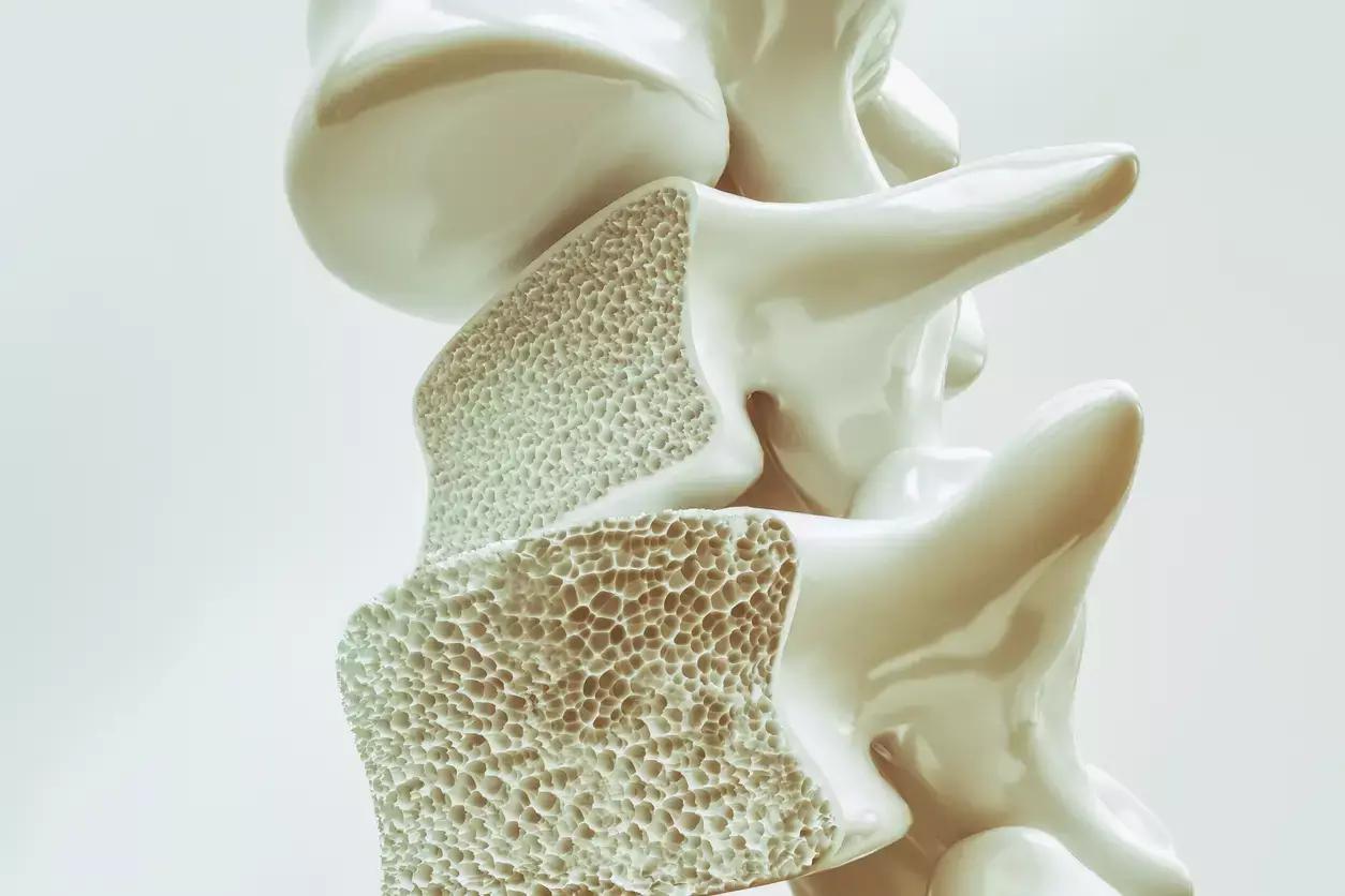Lithium Treatment Decreases Osteoporosis Risk In Patients With Bipolar Disorder: JAMA Study