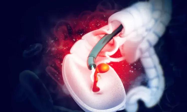 Moderate To Heavy Drinking Linked To Increased Risk Of Early-Onset Colorectal Cancer