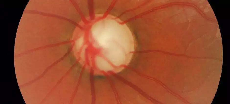 Nocturnal IOP Peak Related To Disease Progression In Glaucoma, Finds Study