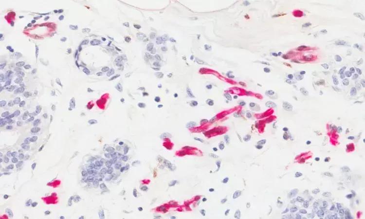 Researchers Describe Mechanism For Link Between Obesity And Breast Cancer
